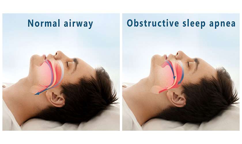 Obstructive Sleep Apnea Treatment