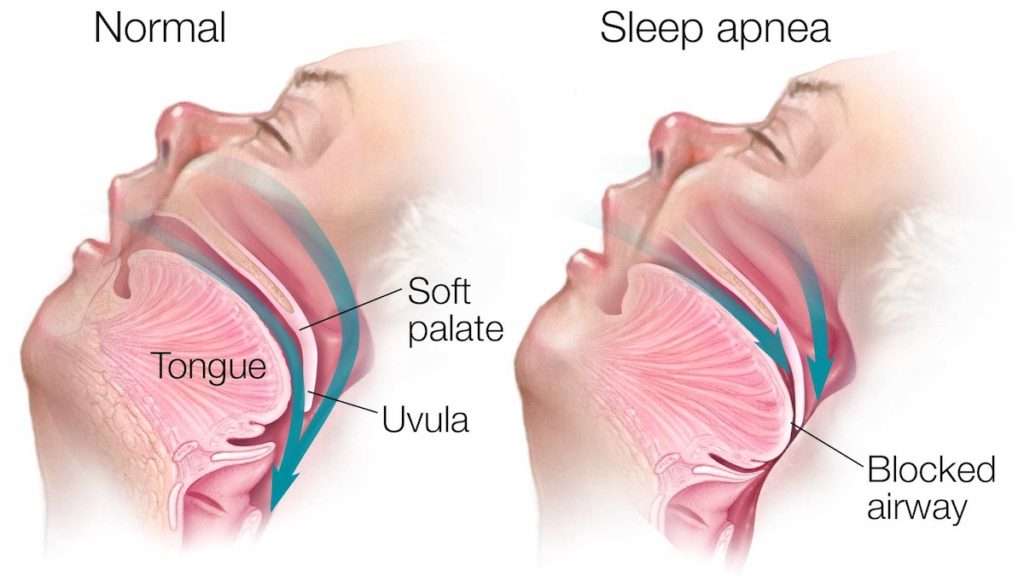 Obstructive Sleep Apnea Treatment